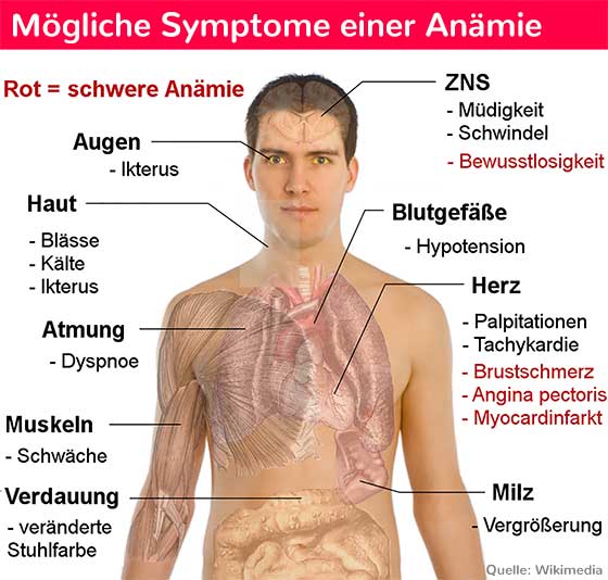 Anämie (Blutarmut): mögliche Symptome
