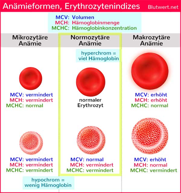 Makrozytäre Anämie: Erythrozytenindizes (MCV, MCH und MCHC) helfen beim Ermitteln der Ursache