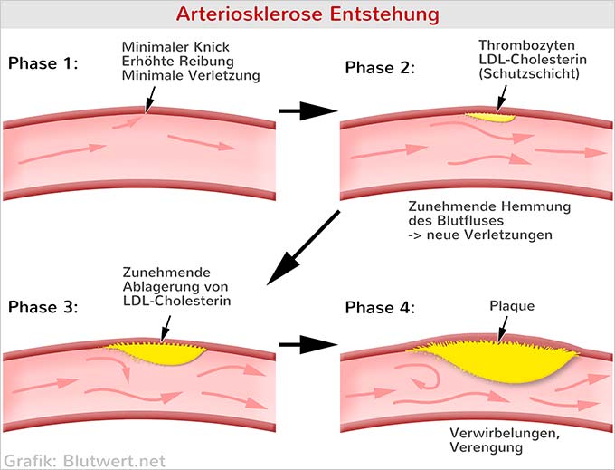 Arteriosklerose Ursachen Folgen Risiken Einfach Erkl rt