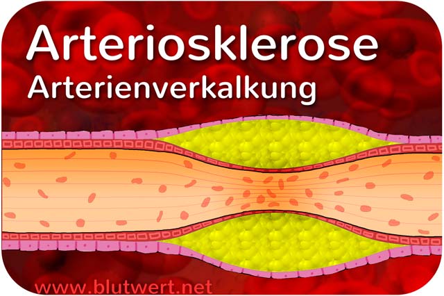 Arteriosklerose