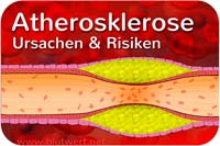 Arteriosklerose: Ursachen und Risiken