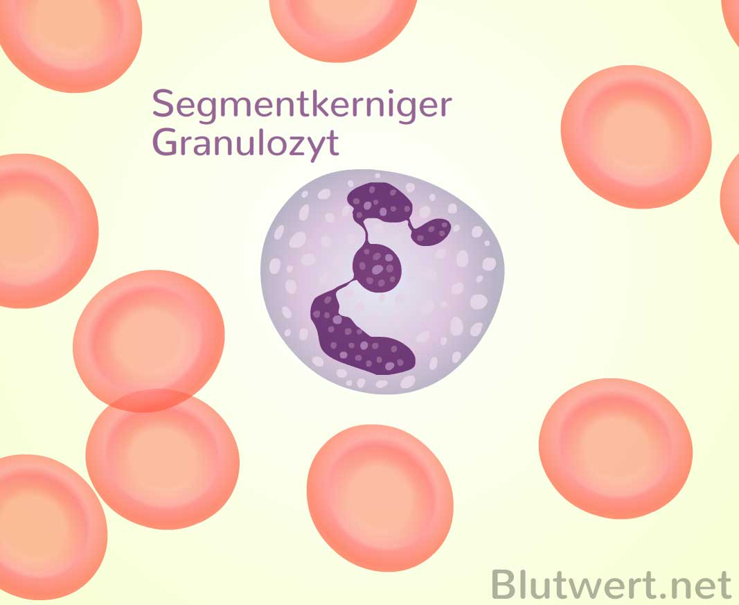 Segmentkernige neutrophile Granulozyten vermindert (Blutwert zu niedrig)