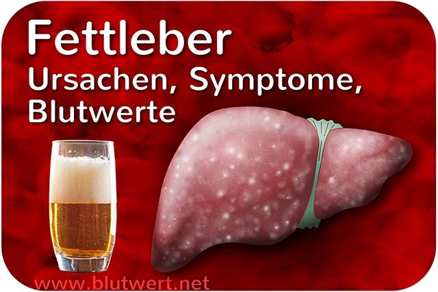 Fettleber: Ursachen, Symptome, Blutwerte