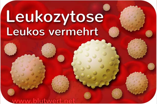 Leukozytose: zu viele Leukozyten