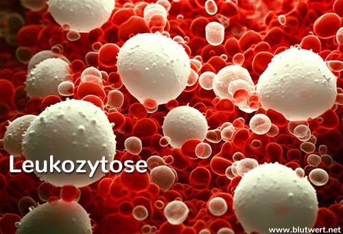 Ursachen einer Leukozytose
