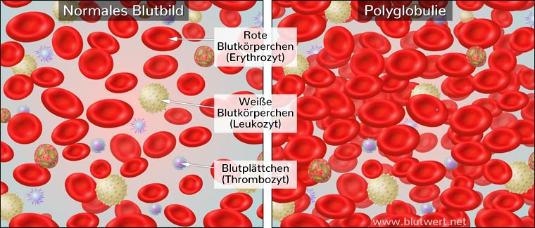 Polyglobulie