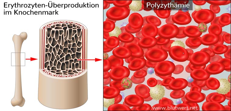 Polyzythämie