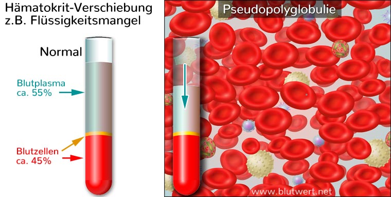 Pseudopolyglobulie