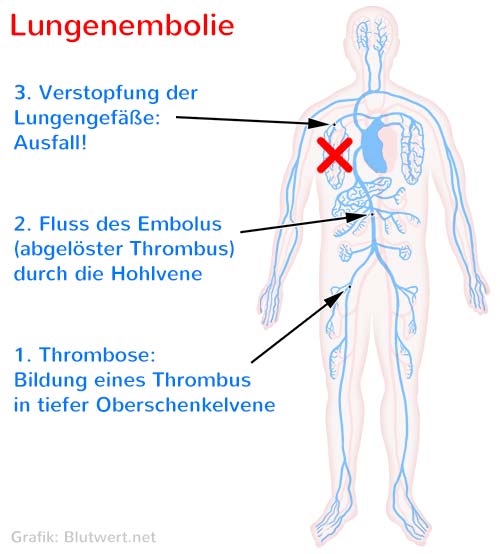 Lungenembolie