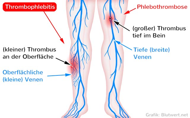 Thrombophlebitis