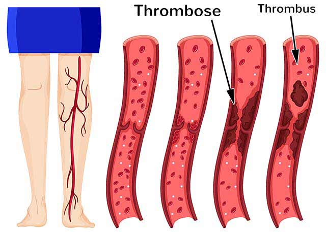 Thrombose Entstehung