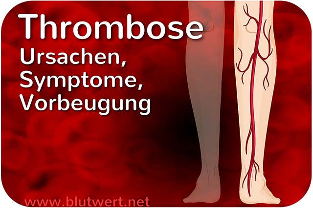 Thrombose: Entstehung eines Thrombus (Blutgerinnsels)