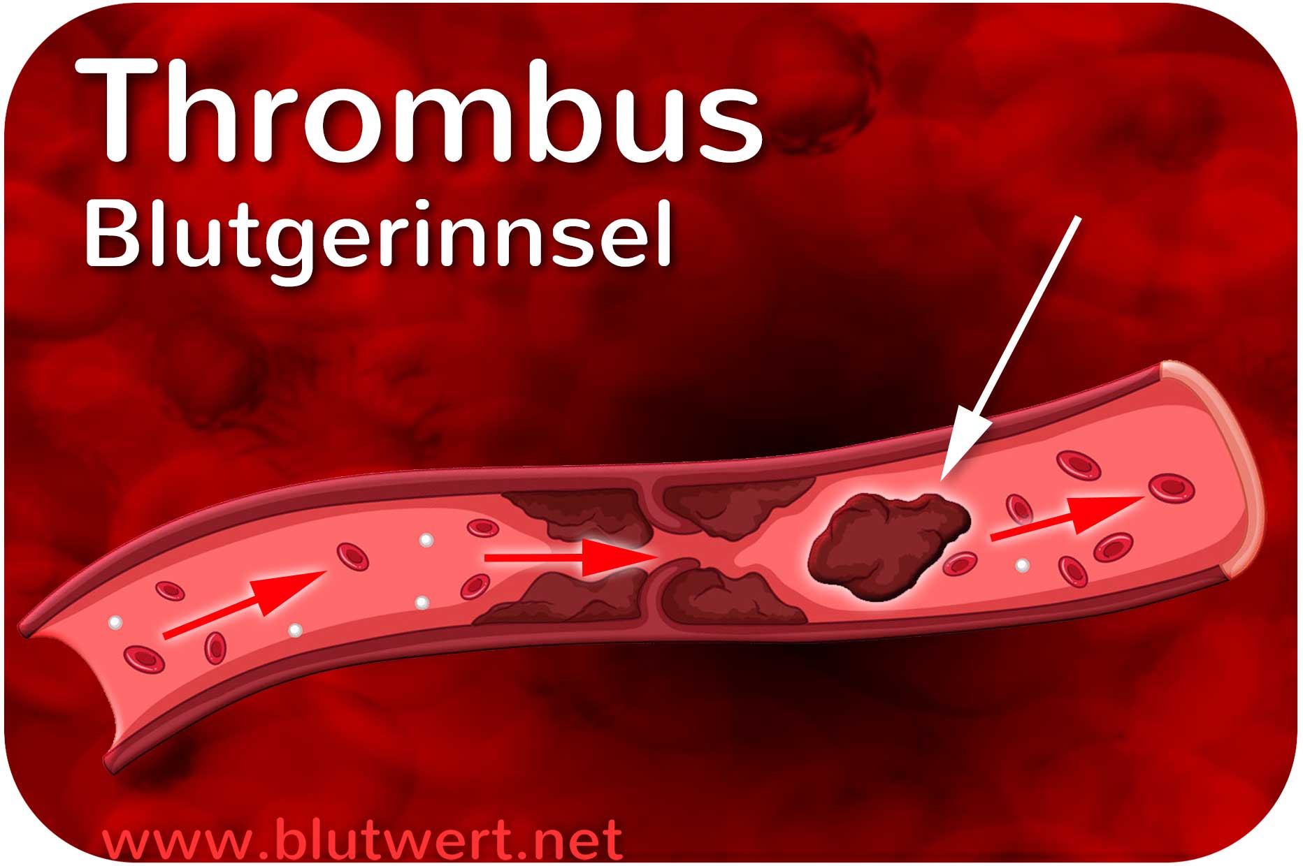 Thrombose Bilder